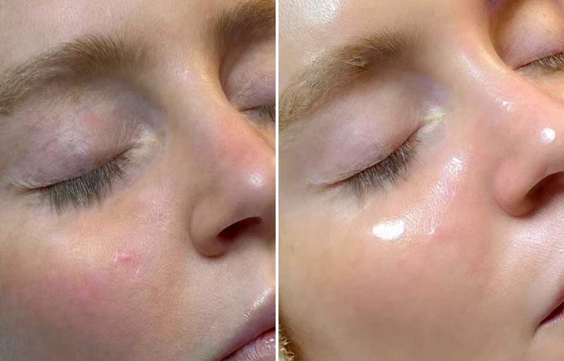 Hydrafacial Before and After